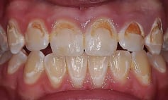 Thông tin Y khoa: Mất calci ở răng (Tên Tiếng Anh: Decaleification, dental)