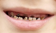 Thông tin Y khoa: Sâu răng (Tên Tiếng Anh: Decay, dental)