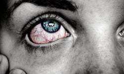 Bị đau mắt đỏ bao lâu thì khỏi? 