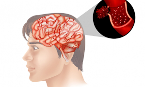 Xử trí, điều trị và tiên lượng bệnh nhồi máu não