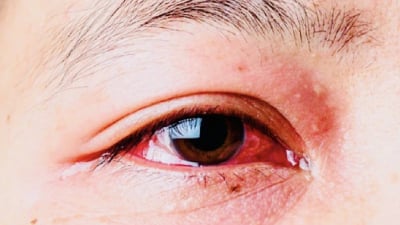 Kiến thức về đau mắt đỏ: Triệu chứng, nguyên nhân, cách điều trị hiệu quả bạn nên biết 