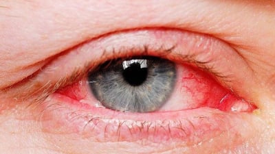 Bệnh đau mắt đỏ: Nguyên nhân, triệu chứng và cách điều trị hiệu quả 