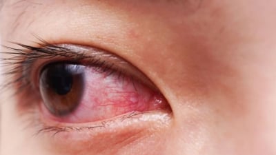Bệnh đau mắt đỏ lây qua đường nào và cách phòng tránh hiệu quả