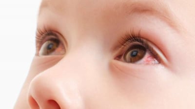 Đau mắt đỏ ở trẻ em: Nguyên nhân, dấu hiệu và cách điều trị 