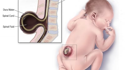 Những điều cần biết về tật nứt đốt sống ở thai nhi 