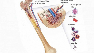 Tổng quan về bệnh suy tuỷ xương: Nguyên nhân, triệu chứng và cách điều trị