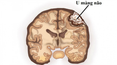 U màng não là gì? Triệu chứng, nguyên nhân và cách điều trị