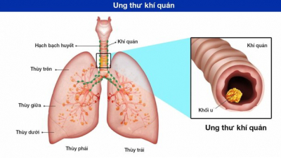 Những điều cần biết về ung thư khí quản: Nguyên nhân, chẩn đoán và cách điều trị 