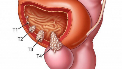 Những điều cần biết về ung thư bàng quang: Nguyên nhân, chẩn đoán và cách điều trị