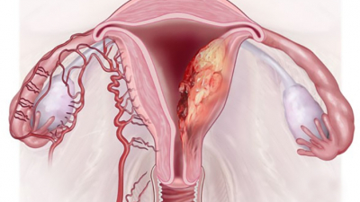 Kiến thức cần biết về ung thư nội mạc tử cung: Nguyên nhân, triệu chứng và cách điều trị