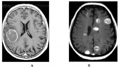 Những điều cơ bản cần biết về ung thư di căn não 