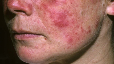 Bệnh lupus ban đỏ có nguy hiểm không?