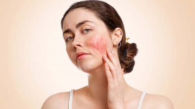 Bệnh lupus ban đỏ: Dấu hiệu và cách điều trị hiệu quả  