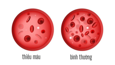 Những điều cần biết về bệnh thiếu máu do thiếu sắt ở trẻ em