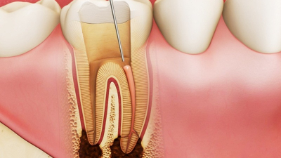 Bệnh viêm tủy răng: Dấu hiệu, biến chứng, cách điều trị và phòng ngừa