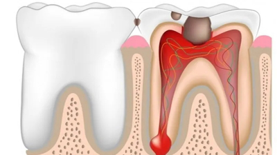 Viêm tuỷ răng nên kiêng ăn gì để hỗ trợ điều trị hiệu quả?