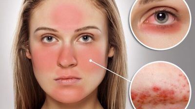 Biểu hiện của bệnh lupus ban đỏ hệ thống và cách điều trị