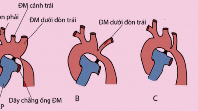 Kiến thức Y học về bệnh hẹp eo động mạch chủ