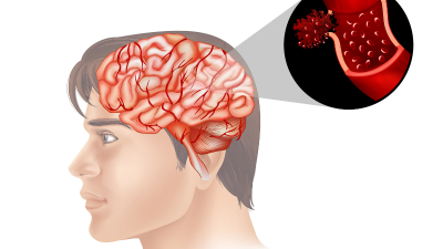 Xử trí, điều trị và tiên lượng bệnh nhồi máu não