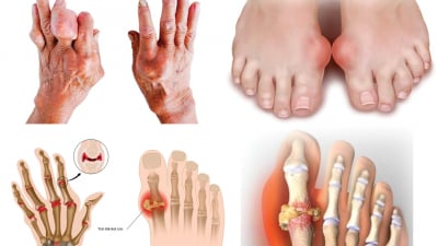 Kiến thức về bệnh gout: Chẩn đoán và cách điều trị 