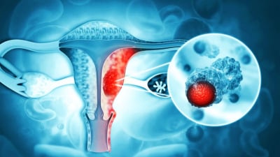 Ung thư cổ tử cung: Triệu chứng/dấu hiệu, nguyên nhân, kiểm tra, chữa trị