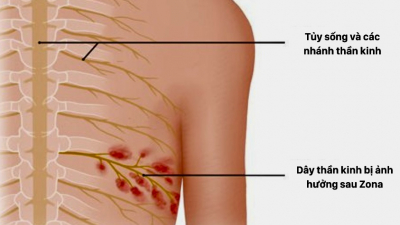 Những điều cần biết về hiện tượng đau thần kinh sau Zona 