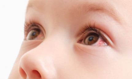 Đau mắt đỏ ở trẻ em: Nguyên nhân, dấu hiệu và cách điều trị 