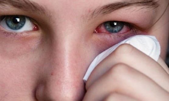 Một số mẹo chữa đau mắt đỏ nhanh nhất, hiệu quả nhất 