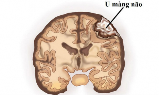 U màng não là gì? Triệu chứng, nguyên nhân và cách điều trị