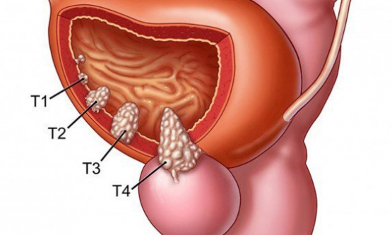 Những điều cần biết về ung thư bàng quang: Nguyên nhân, chẩn đoán và cách điều trị