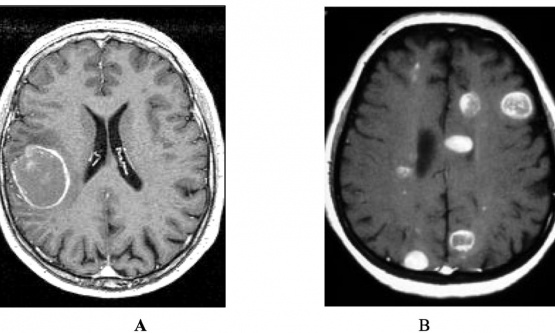 Những điều cơ bản cần biết về ung thư di căn não 