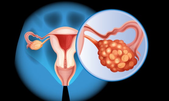 Ung thư buồng trứng: Nguyên nhân và dấu hiệu