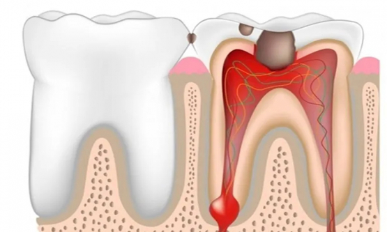 Viêm tuỷ răng nên kiêng ăn gì để hỗ trợ điều trị hiệu quả?