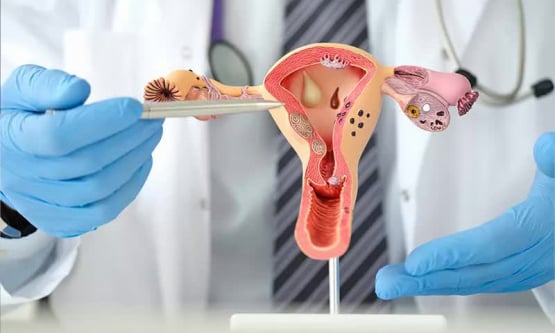 Hội chứng buồng trứng đa nang: Nguyên nhân, triệu chứng và cách phòng ngừa