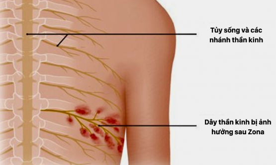 Những điều cần biết về hiện tượng đau thần kinh sau Zona 