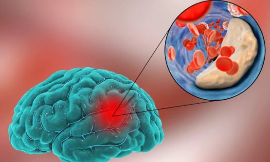 Những điều cần biết về bệnh nhồi máu não 